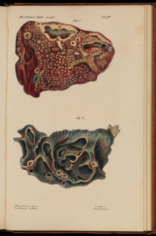 1834 anatomic drawing of pulmonary consumption (tuberculosis). Lungwort has spotted leaves reminiscent of the diseased lung seen on top.